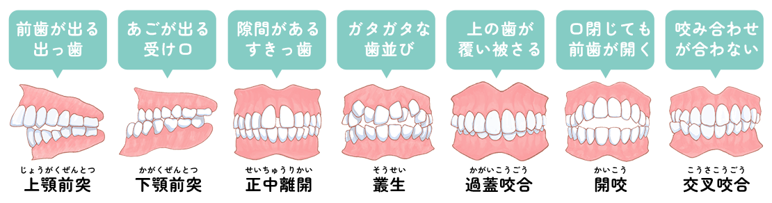 不正咬合
