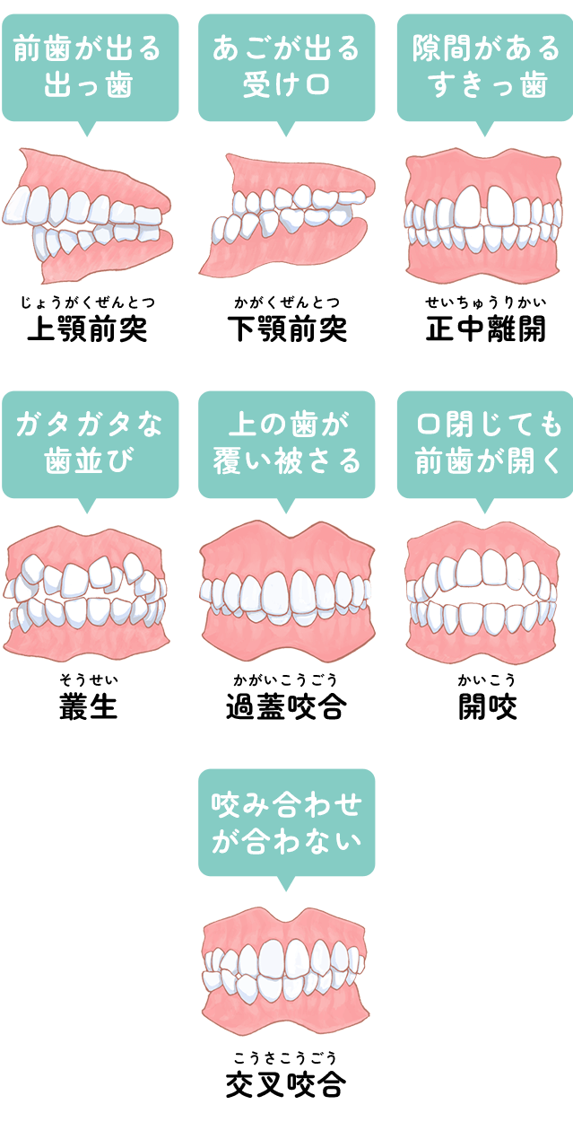 不正咬合