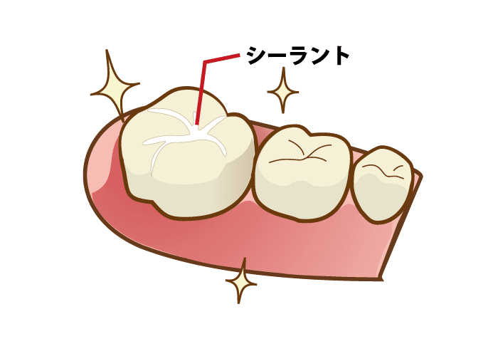 シーラント