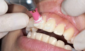歯の表面の清掃