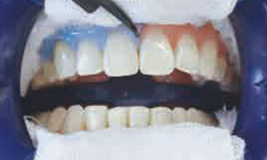 ホワイトニング剤塗布