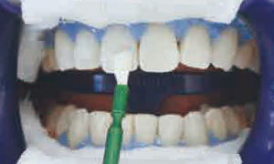 ホワイトニング剤塗布